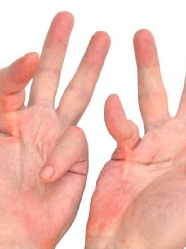 Enfermedad de Dupuytren