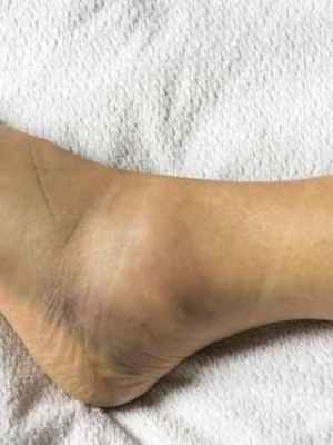 El esguince de tobillo, una lesión&nbsp;subestimada